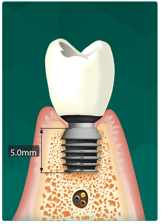 Bicon Dental Implants