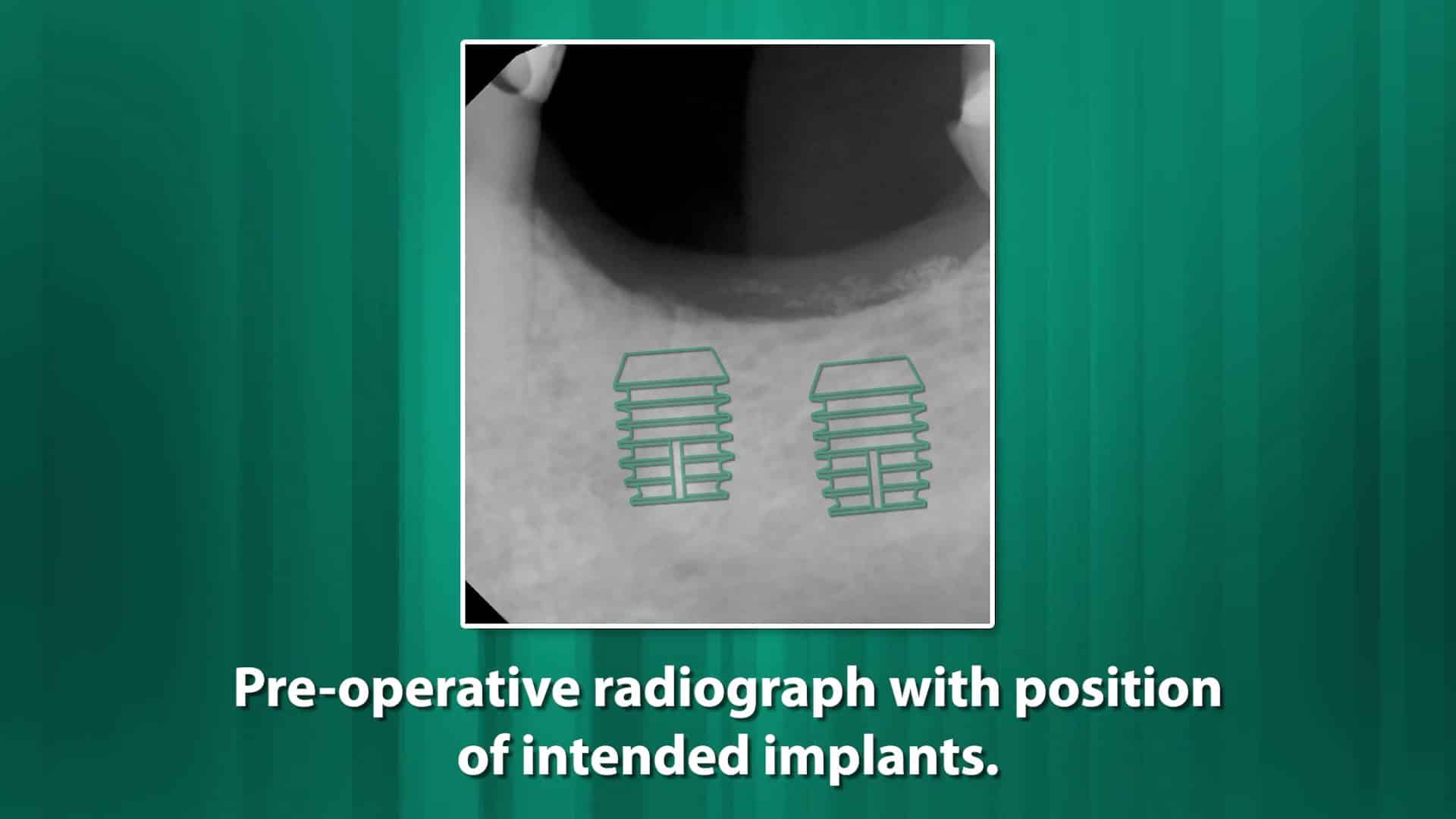 One Stage Placement Of Two Adjacent X Mm Short Implants For Mandibular Premolars Bicon