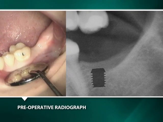 Placement And Restoration Of A Bicon Short Implant Bicon Dental Implants