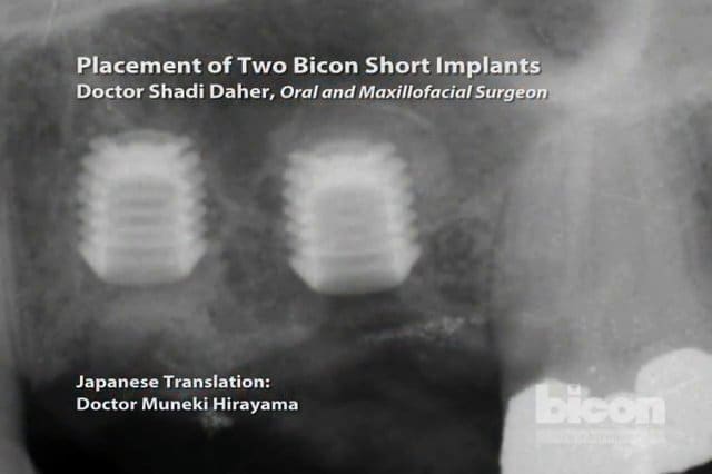 Placement Of Two Bicon Short Implants Bicon Dental Implants