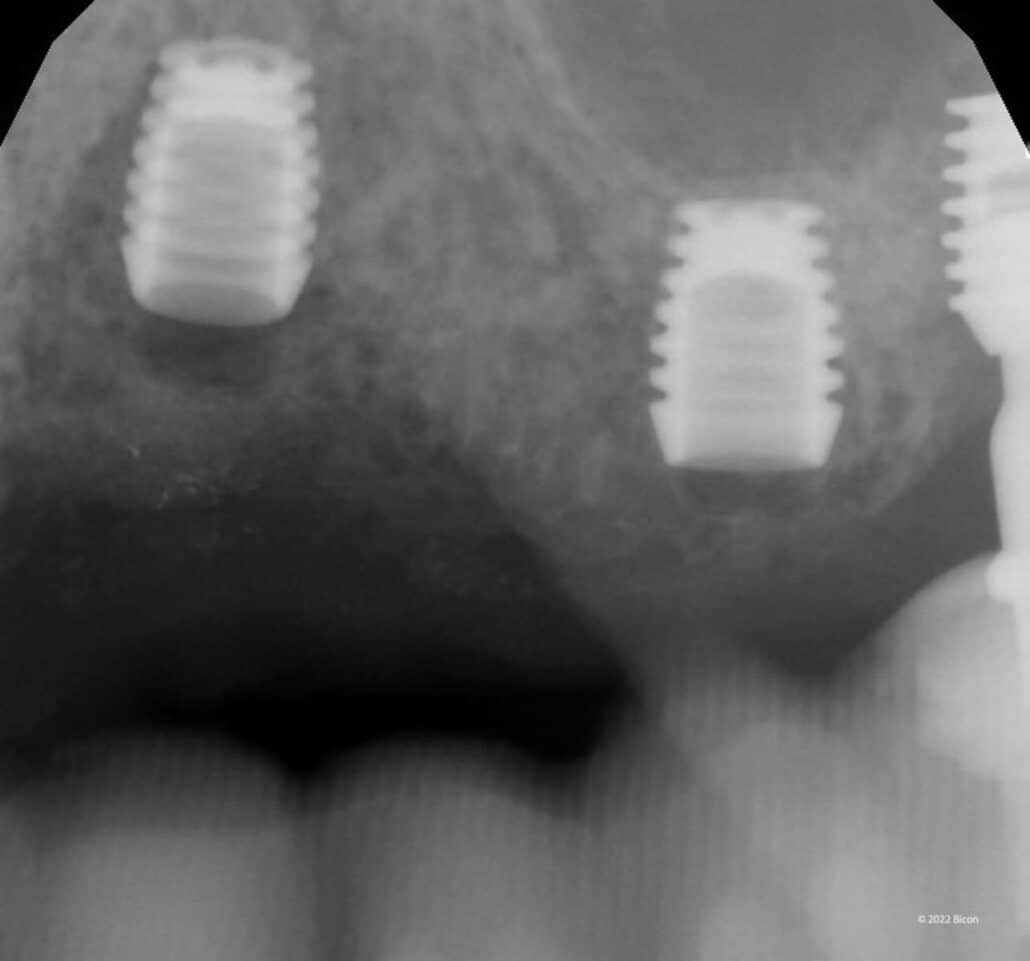 Replacement Of A Failed Full Arch Maxillary PFM Prosthesis With A TRINIA Full Arch Prosthesis