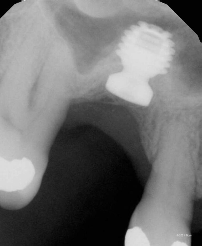 Seven-Year Radiographic Follow Up Of A 6.0 X 5.0mm Bicon SHORT® Implant ...