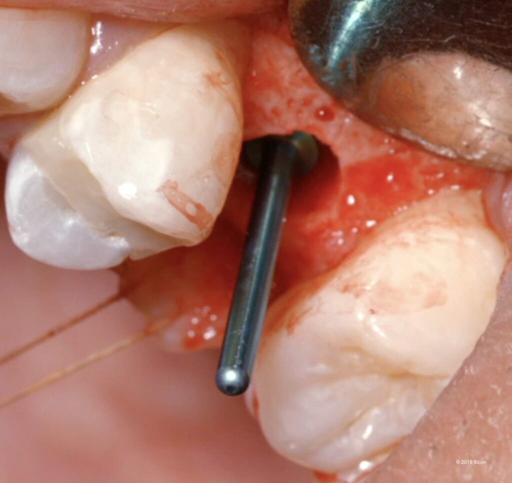 Two-Stage Placement Of A 5.0 X 6.0mm Bicon SHORT® Implant For A ...