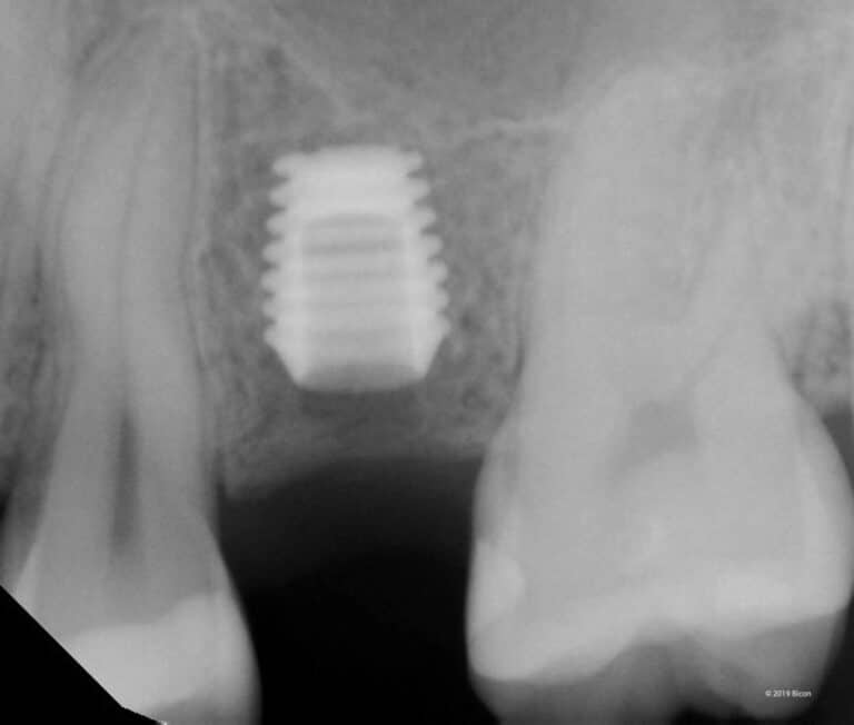 Two-Stage Placement Of A 5.0 X 6.0mm Bicon SHORT® Implant For A ...