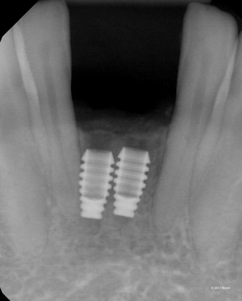 Anterior Placement Of Two 3.0 X 6.0mm SHORT® Implants With Mandibular ...