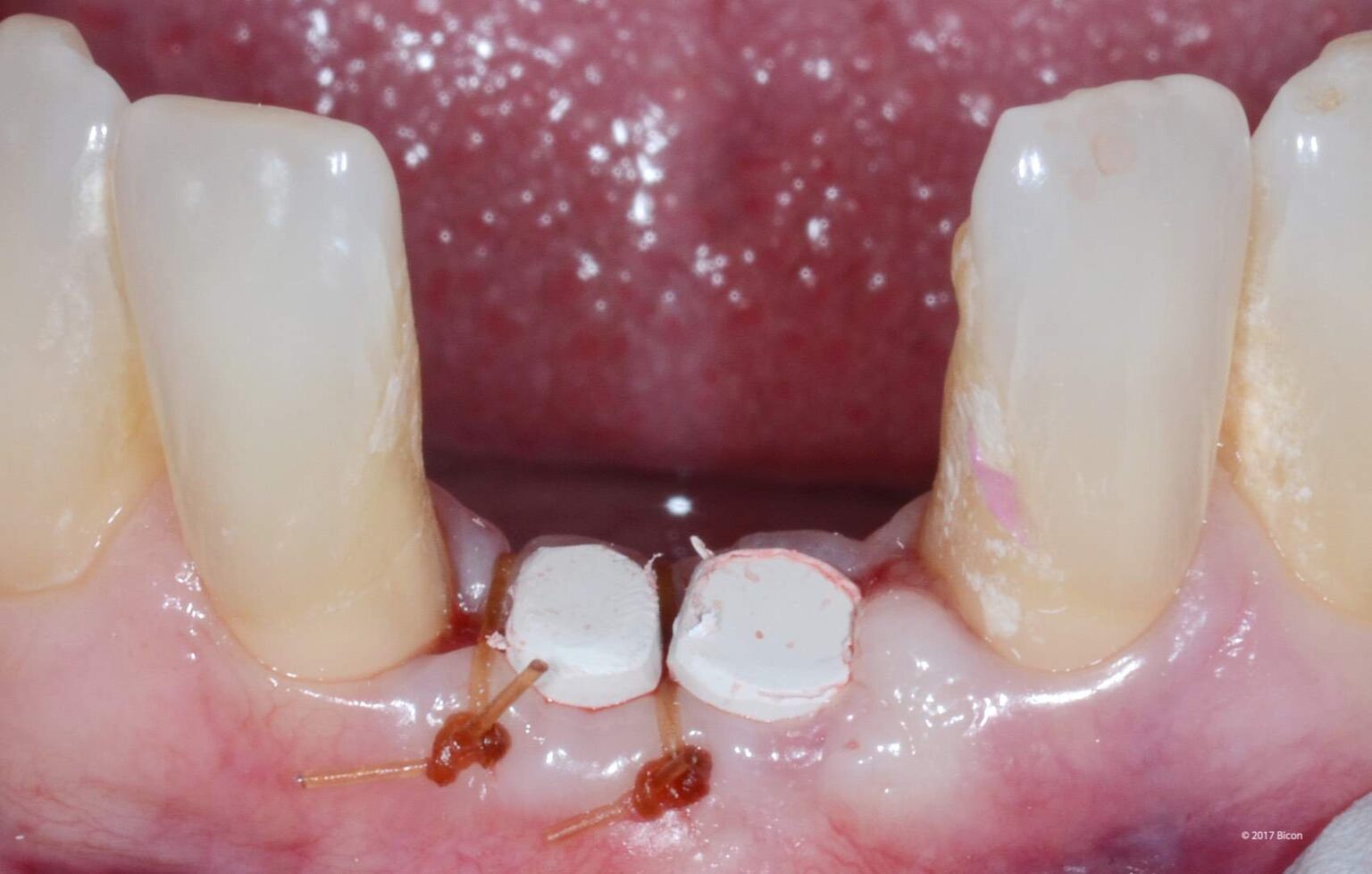 Anterior Placement Of Two 3.0 X 6.0mm SHORT® Implants With Mandibular ...