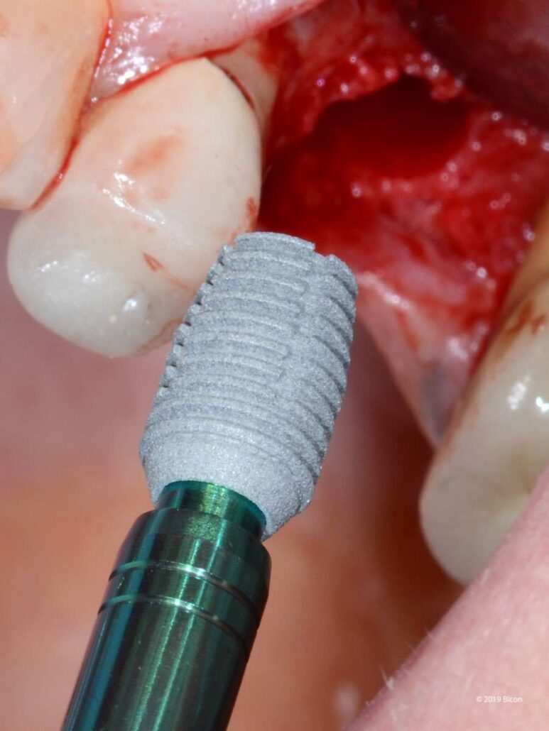 One-Stage Placement Of A 5.0 X 8.0mm Bicon SHORT® Implant For A ...