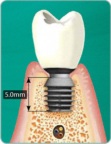 Bicon Dental Implants Short Implants
